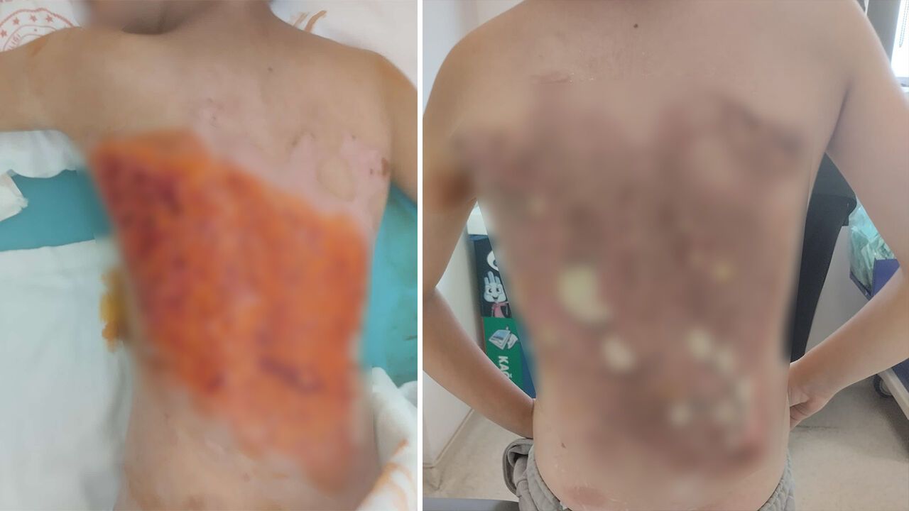 Arnavutköy'de 12 yaşındaki çocuk akran zorbalığına uğradı, kolonya ile yanıklandı