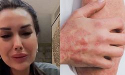 Dilan Polat'ın Hastalığı Lupus Hastalığı Nedir, Belirtileri Nelerdir? Kelebek Hastalığı Tedavisi Var Mı?